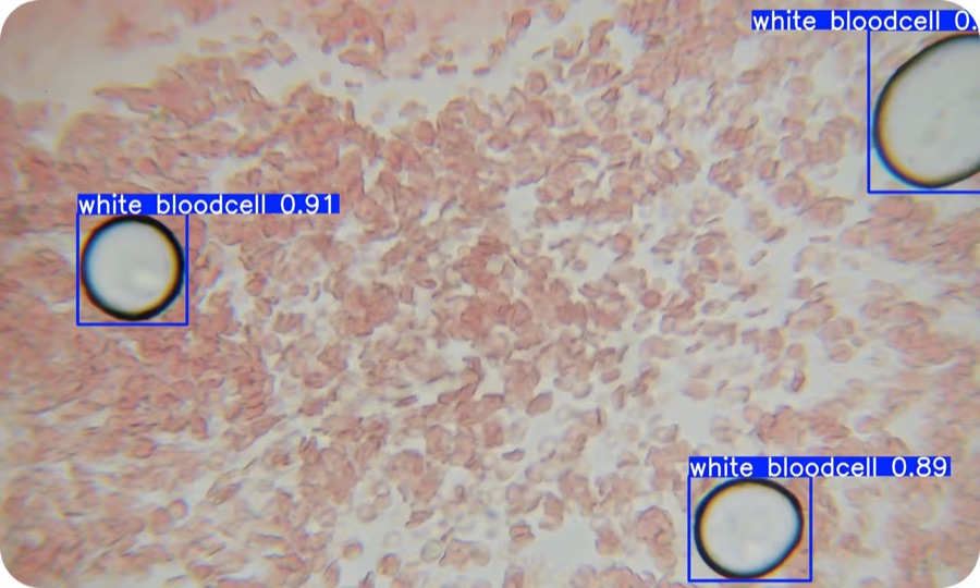 AI model detecting and counting white blood cells under a microscope