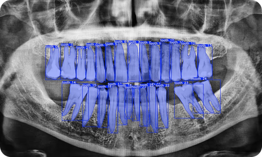 AI model segmenting individual teeth on a panoramic dental X-ray
