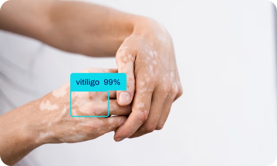 AI model detecting vitiligo on skin with a confidence score